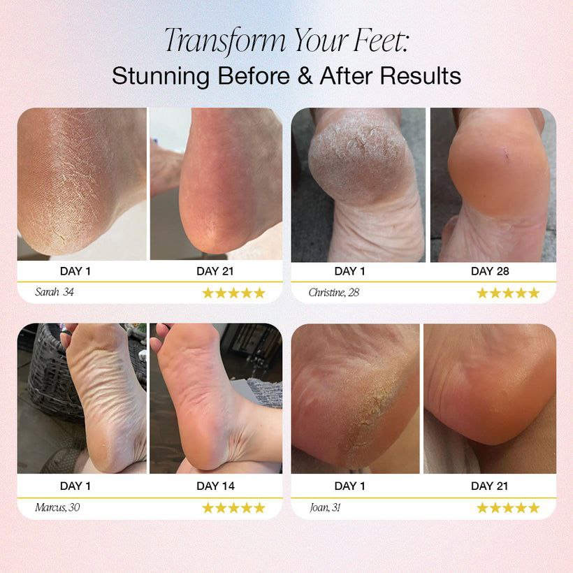 InstantRelief™  Electric Foot Callus Remover